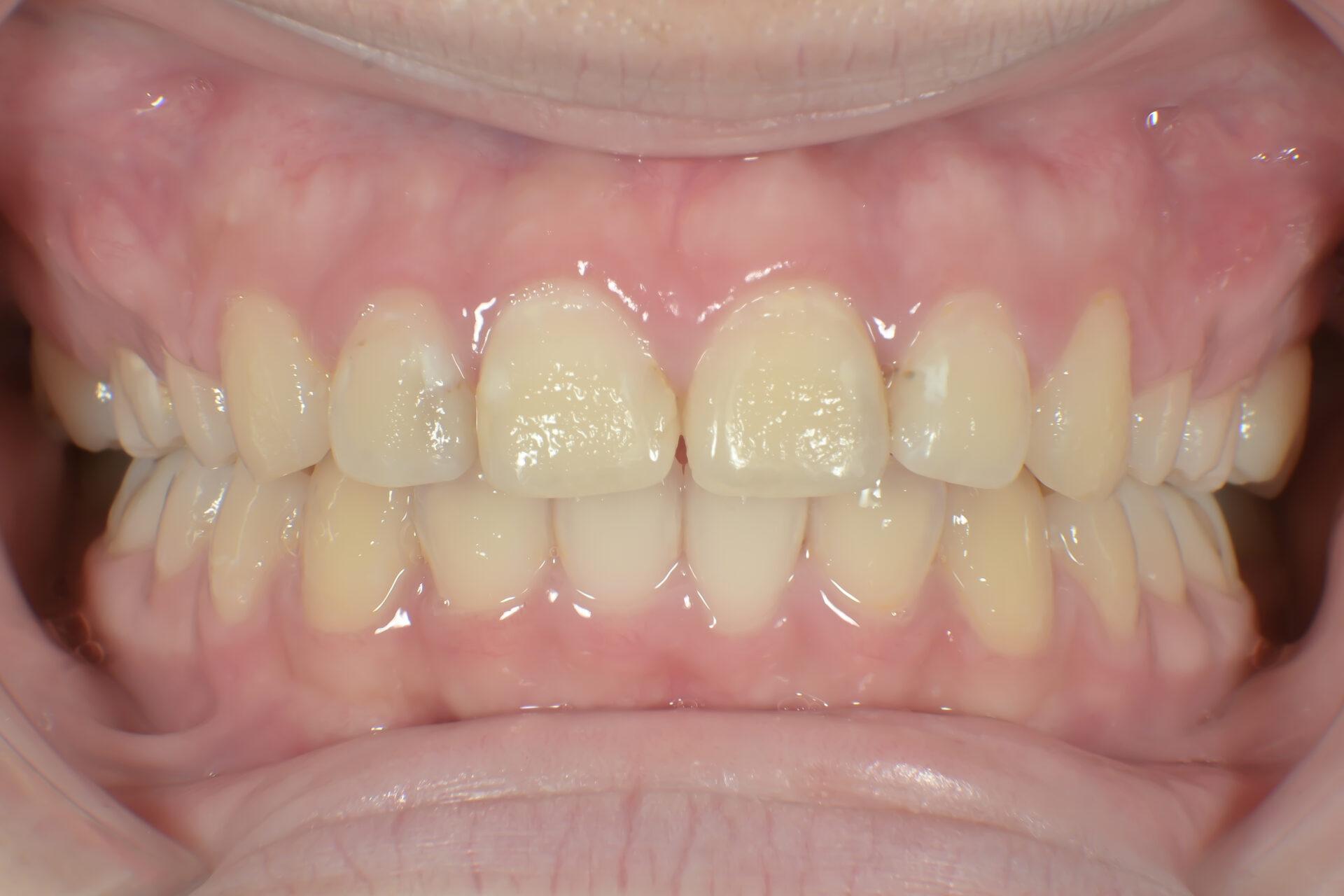 過蓋咬合(深い噛み合わせ)を改善した症例治療方法08