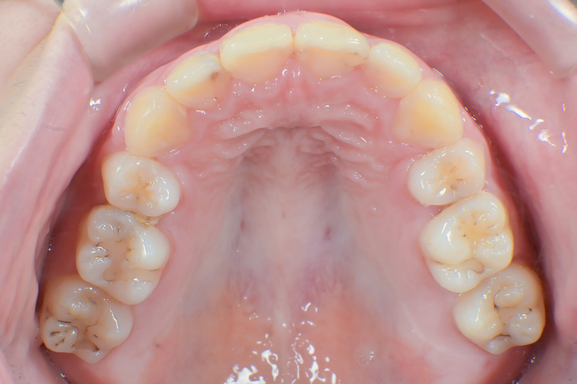 過蓋咬合(深い噛み合わせ)を改善した症例治療方法09