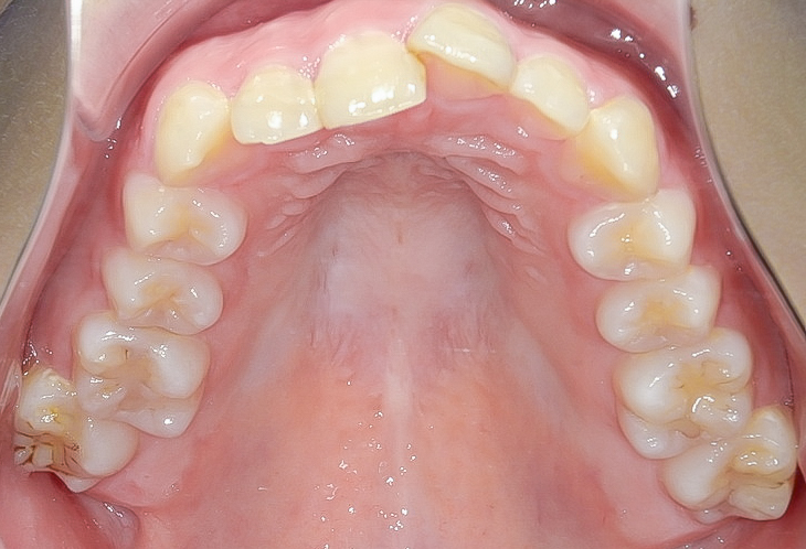 過蓋咬合(深い噛み合わせ)を改善した症例治療方法02