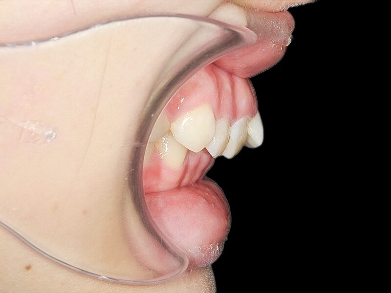 過蓋咬合(深い噛み合わせ)を改善した症例治療方法01