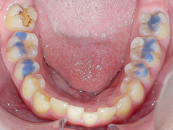 過蓋咬合(深い噛み合わせ)を改善した症例治療方法05