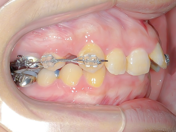 過蓋咬合(深い噛み合わせ)を改善した症例治療方法04
