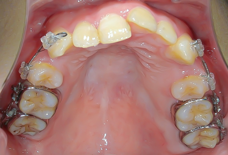 過蓋咬合(深い噛み合わせ)を改善した症例治療方法03