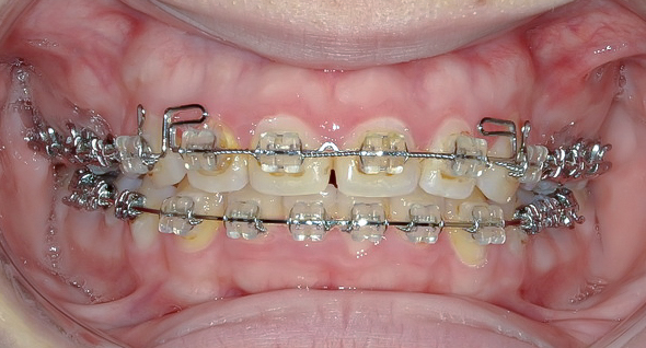 過蓋咬合(深い噛み合わせ)を改善した症例治療方法07