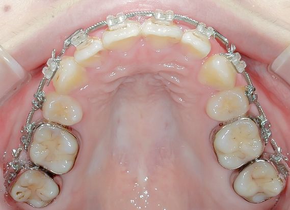 過蓋咬合(深い噛み合わせ)を改善した症例治療方法06